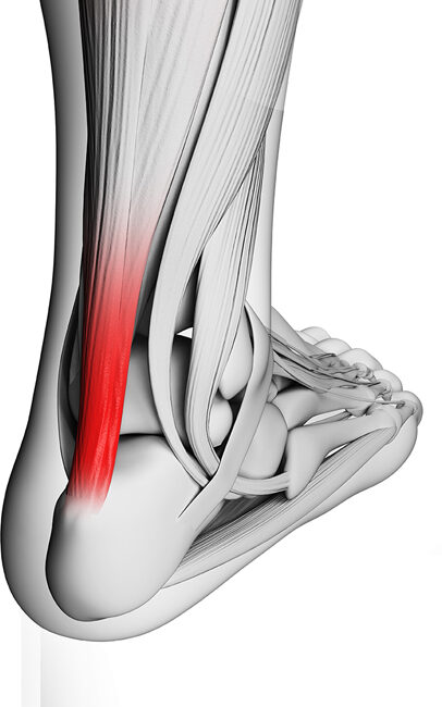 illustration-rendu-du-tendon-d'Achille