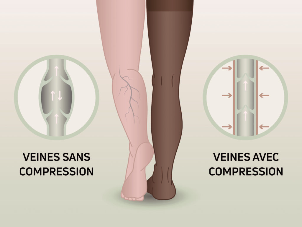Schéma compression veineuse